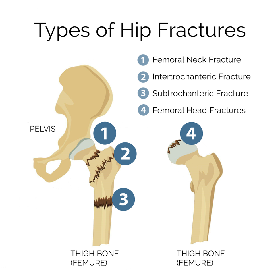 Types of Hip Fractures