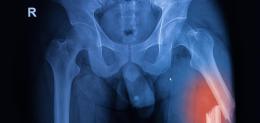 X-ray-image-of-both-hip-showing-femur-fracture-at-left-side