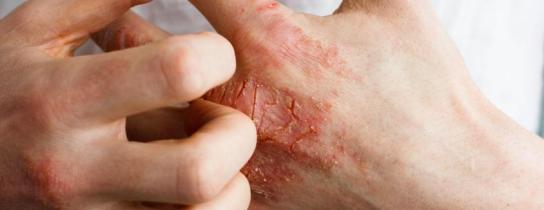 eczema-on-hand