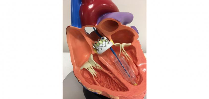 Aortic Stenosis and the TAVR Procedure, What You Should